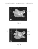 HEART TISSUE SURFACE CONTOUR-BASED RADIOSURGICAL TREATMENT PLANNING diagram and image