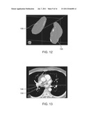 HEART TISSUE SURFACE CONTOUR-BASED RADIOSURGICAL TREATMENT PLANNING diagram and image