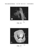 HEART TISSUE SURFACE CONTOUR-BASED RADIOSURGICAL TREATMENT PLANNING diagram and image