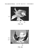 HEART TISSUE SURFACE CONTOUR-BASED RADIOSURGICAL TREATMENT PLANNING diagram and image