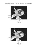 HEART TISSUE SURFACE CONTOUR-BASED RADIOSURGICAL TREATMENT PLANNING diagram and image