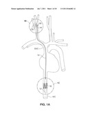 SYSTEM AND METHOD FOR TRANSVASCULARLY STIMULATING CONTENTS OF THE CAROTID     SHEATH diagram and image