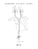 SYSTEM AND METHOD FOR TRANSVASCULARLY STIMULATING CONTENTS OF THE CAROTID     SHEATH diagram and image