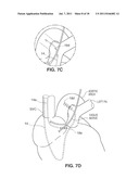 SYSTEM AND METHOD FOR TRANSVASCULARLY STIMULATING CONTENTS OF THE CAROTID     SHEATH diagram and image