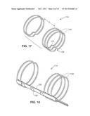 SYSTEM AND METHOD FOR TRANSVASCULARLY STIMULATING CONTENTS OF THE CAROTID     SHEATH diagram and image