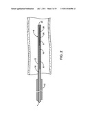 SYSTEMS, METHODS AND DEVICES FOR REMOVING OBSTRUCTIONS FROM A BLOOD VESSEL diagram and image