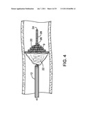 SYSTEMS, METHODS AND DEVICES FOR REMOVING OBSTRUCTIONS FROM A BLOOD VESSEL diagram and image