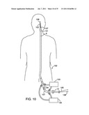 SYSTEMS, METHODS AND DEVICES FOR REMOVING OBSTRUCTIONS FROM A BLOOD VESSEL diagram and image