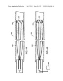 SYSTEMS, METHODS AND DEVICES FOR REMOVING OBSTRUCTIONS FROM A BLOOD VESSEL diagram and image