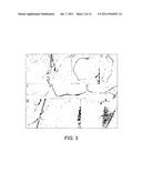 RECANALIZING OCCLUDED VESSELS USING CONTROLLED ANTEGRADE AND RETROGRADE     TRACKING diagram and image
