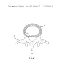 METHOD AND DEVICE FOR PLACING MATERIALS IN THE SPINE diagram and image