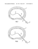 METHOD AND DEVICE FOR PLACING MATERIALS IN THE SPINE diagram and image