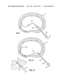 METHOD AND DEVICE FOR PLACING MATERIALS IN THE SPINE diagram and image