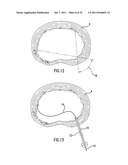 METHOD AND DEVICE FOR PLACING MATERIALS IN THE SPINE diagram and image