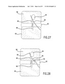 METHOD AND DEVICE FOR PLACING MATERIALS IN THE SPINE diagram and image