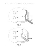 METHOD AND DEVICE FOR PLACING MATERIALS IN THE SPINE diagram and image