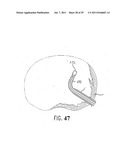 METHOD AND DEVICE FOR PLACING MATERIALS IN THE SPINE diagram and image