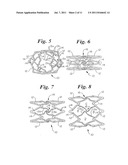 Stent Configurations diagram and image