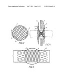 Stent diagram and image