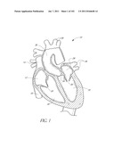 PROFILE REDUCTION OF VALVE IMPLANT diagram and image