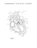 PROFILE REDUCTION OF VALVE IMPLANT diagram and image