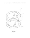 PROFILE REDUCTION OF VALVE IMPLANT diagram and image