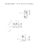 PROFILE REDUCTION OF VALVE IMPLANT diagram and image