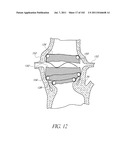 PROFILE REDUCTION OF VALVE IMPLANT diagram and image