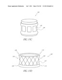 PROFILE REDUCTION OF VALVE IMPLANT diagram and image