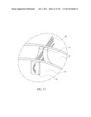 PROFILE REDUCTION OF VALVE IMPLANT diagram and image