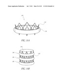 PROFILE REDUCTION OF VALVE IMPLANT diagram and image