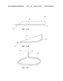 PROFILE REDUCTION OF VALVE IMPLANT diagram and image