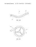 PROFILE REDUCTION OF VALVE IMPLANT diagram and image