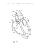 PROFILE REDUCTION OF VALVE IMPLANT diagram and image