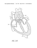 PROFILE REDUCTION OF VALVE IMPLANT diagram and image