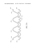 PROFILE REDUCTION OF VALVE IMPLANT diagram and image