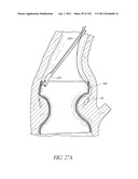 PROFILE REDUCTION OF VALVE IMPLANT diagram and image