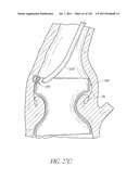 PROFILE REDUCTION OF VALVE IMPLANT diagram and image