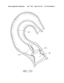 PROFILE REDUCTION OF VALVE IMPLANT diagram and image