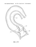 PROFILE REDUCTION OF VALVE IMPLANT diagram and image