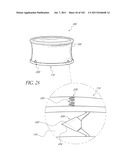 PROFILE REDUCTION OF VALVE IMPLANT diagram and image