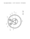 PROFILE REDUCTION OF VALVE IMPLANT diagram and image