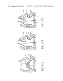 PROFILE REDUCTION OF VALVE IMPLANT diagram and image