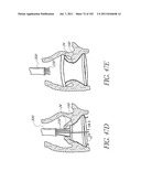 PROFILE REDUCTION OF VALVE IMPLANT diagram and image