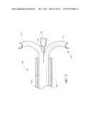 PROFILE REDUCTION OF VALVE IMPLANT diagram and image