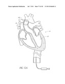 PROFILE REDUCTION OF VALVE IMPLANT diagram and image