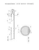 PROFILE REDUCTION OF VALVE IMPLANT diagram and image