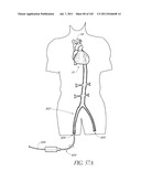 PROFILE REDUCTION OF VALVE IMPLANT diagram and image