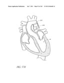 PROFILE REDUCTION OF VALVE IMPLANT diagram and image