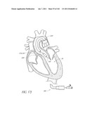 PROFILE REDUCTION OF VALVE IMPLANT diagram and image